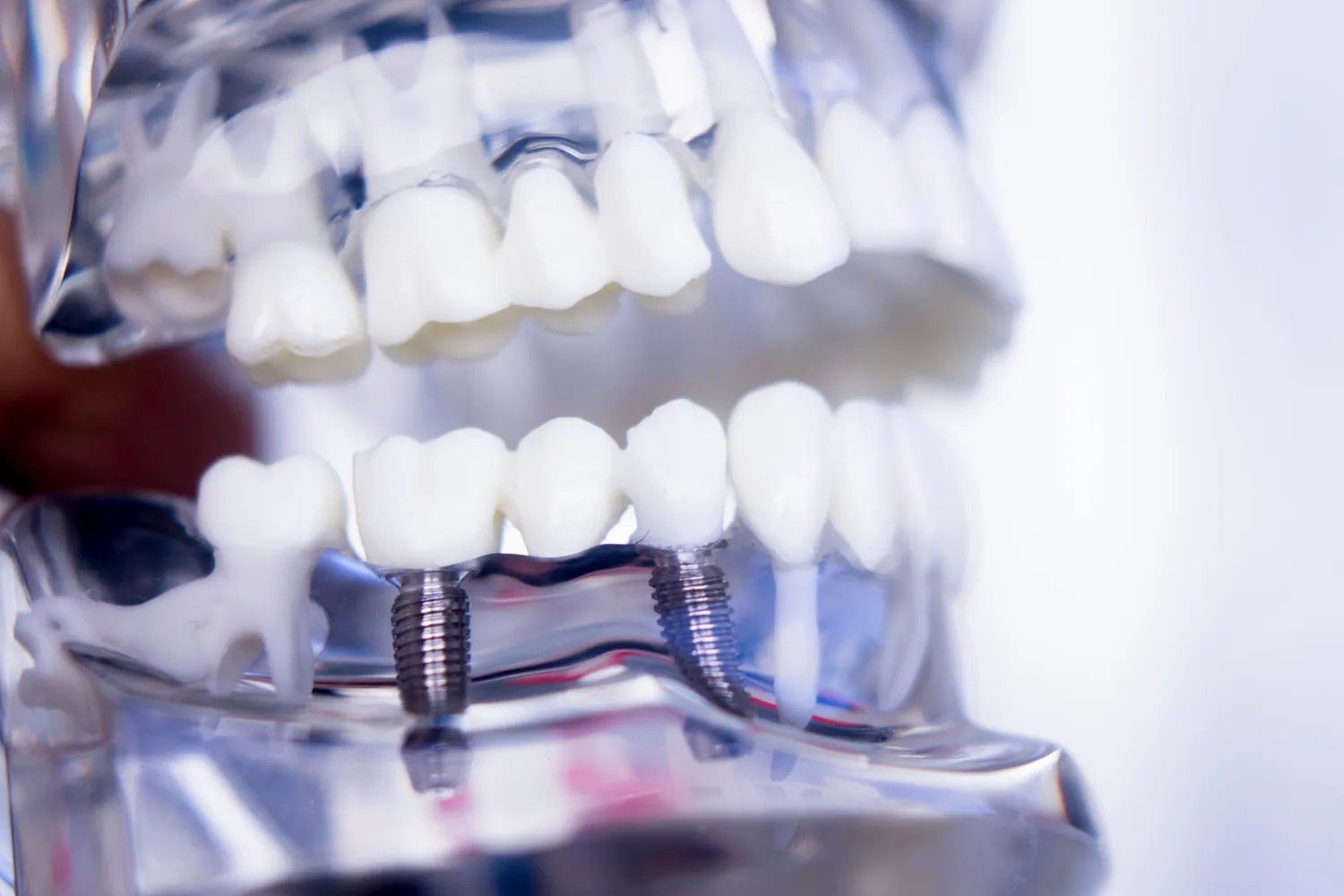 Implanty zębowe - proces zakładania implantu zębowego